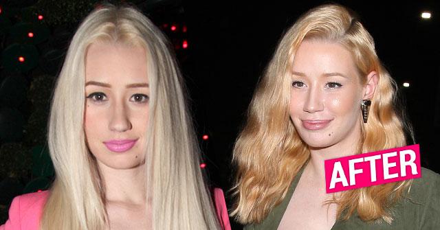 ggy Azalea Plastic Surgery Face Before After Photos