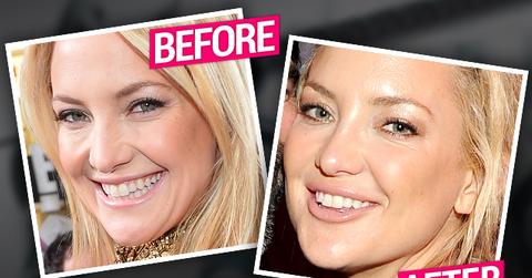 Kate Hudson Plastic Surgery