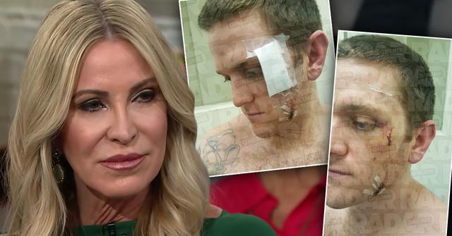 ‘RHOC’ Star Josh Waring Suffers Horrific Wounds In Jail Attack: PHOTOS