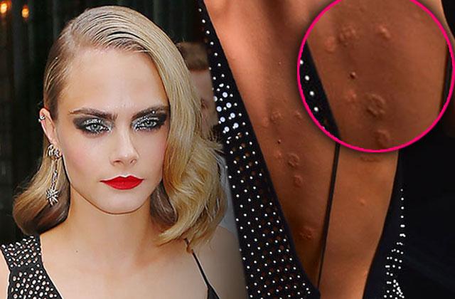 OUCH! Cara Delevingne Is Covered In Painful Looking Welts