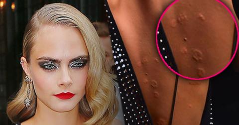 cara delevingne welts bumps rash back suicide square premiere