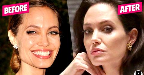 Angelina Jolie Facelift
