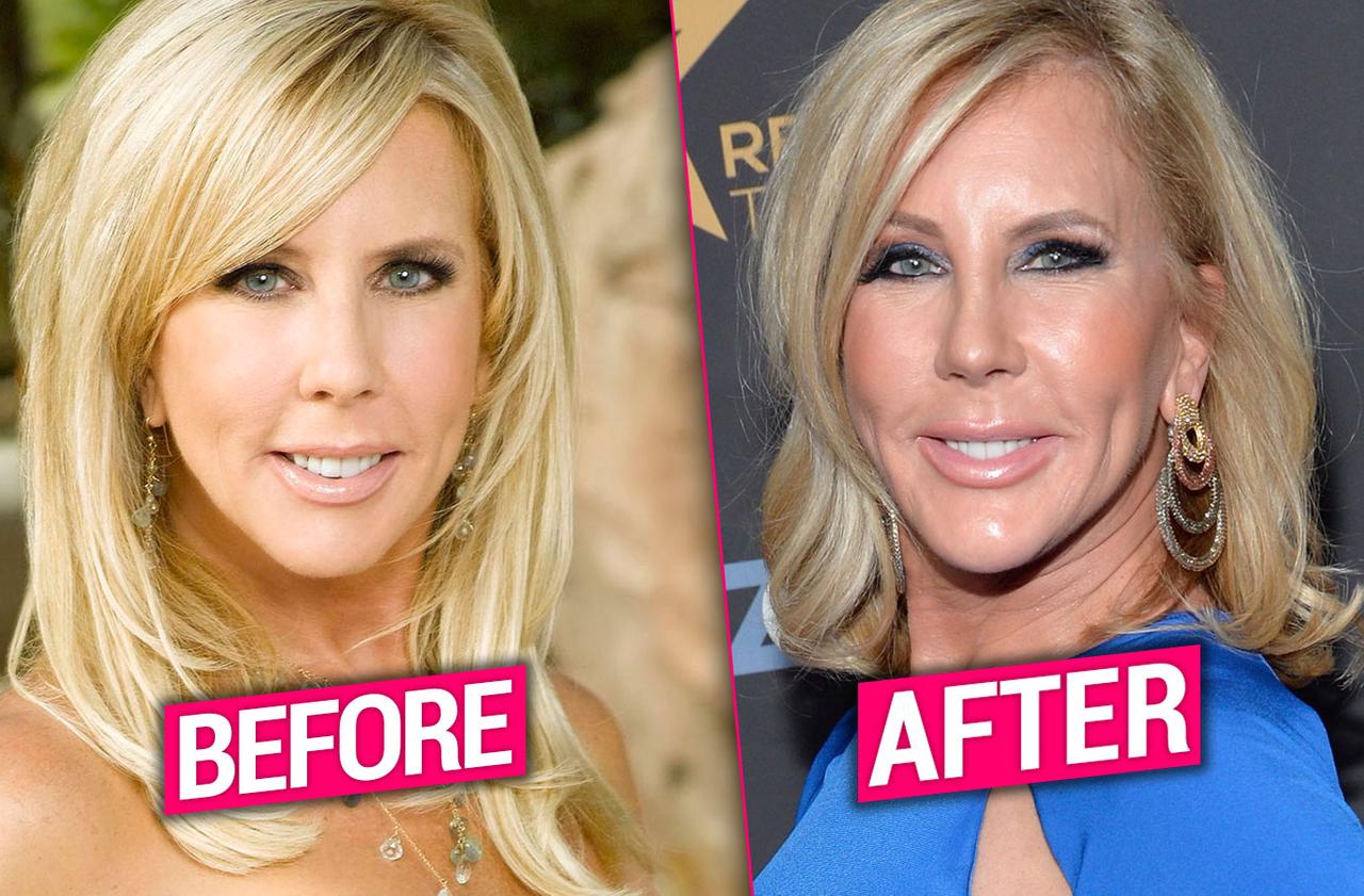 [PICS] ‘RHOC’ Vet Vicki Gunvalson’s Plastic Surgery Transformation Exposed