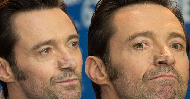 Hugh Jackman Cancer Skin Surgery Spotted Healthy