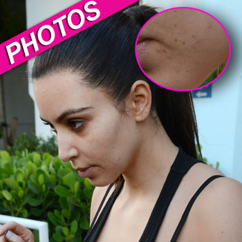 kim kardashian acne marks