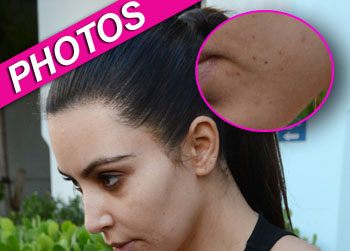 //kim kardashian acne