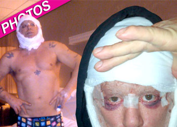 //mickey rourke plastic surgery_