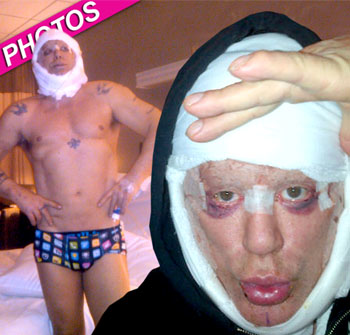 //mickey rourke plastic surgery_