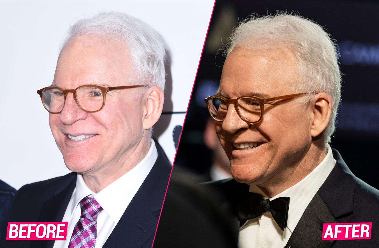 Laugh Lines? Leading Plastic Surgeons Break Down Comedian Steve Martin’s Secrets To His Youthful Look at 74