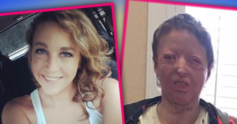 burn victim mom finds love