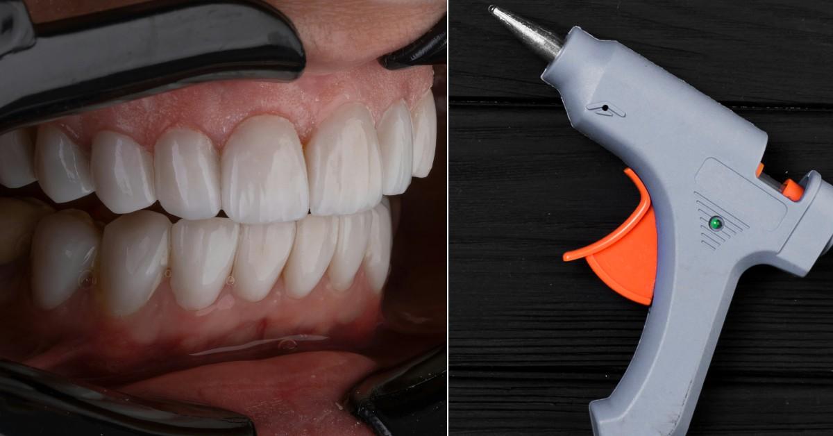 Photo of teeth, glue gun.