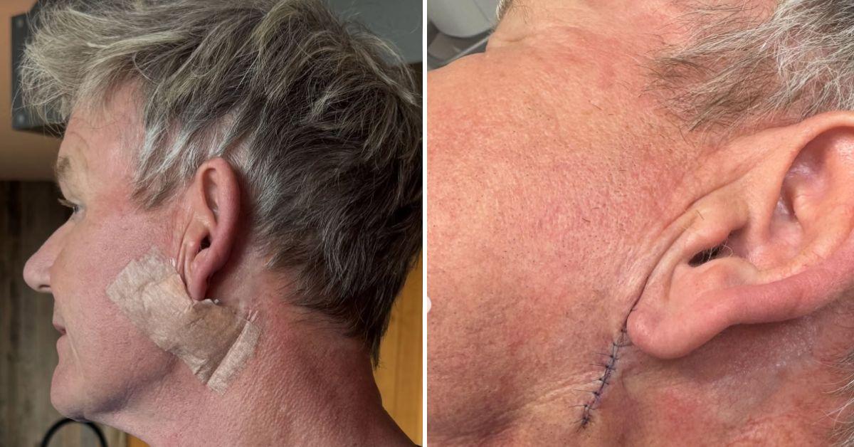 gordon ramsay cancer tv star stitched up face emergency surgery