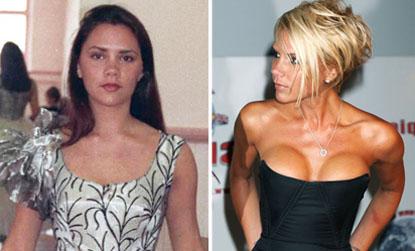 //victoria beckham plastic surgery by age