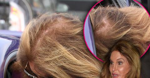 caitlyn jenner bald spot hair loss