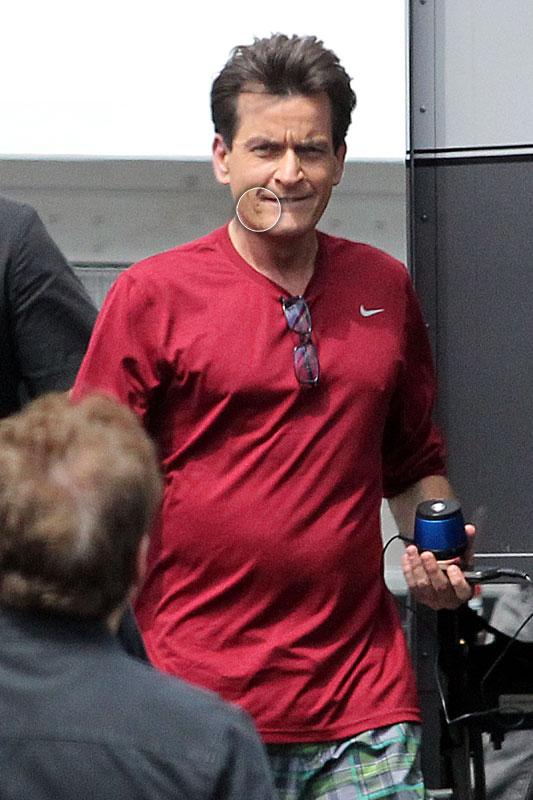 Charlie Sheen HIV Positive Lesions Face