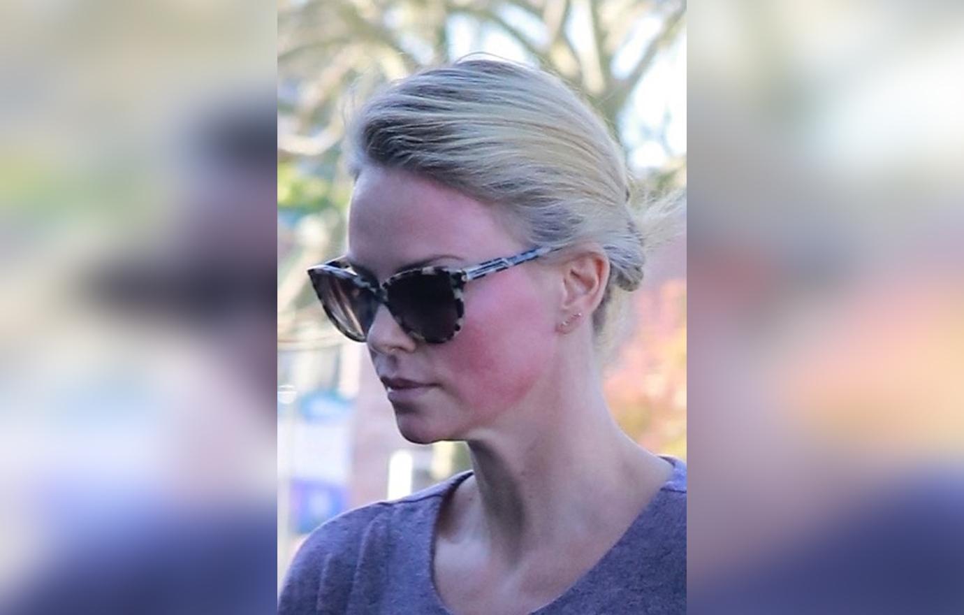 charlize theron face nasty welts facial procedure