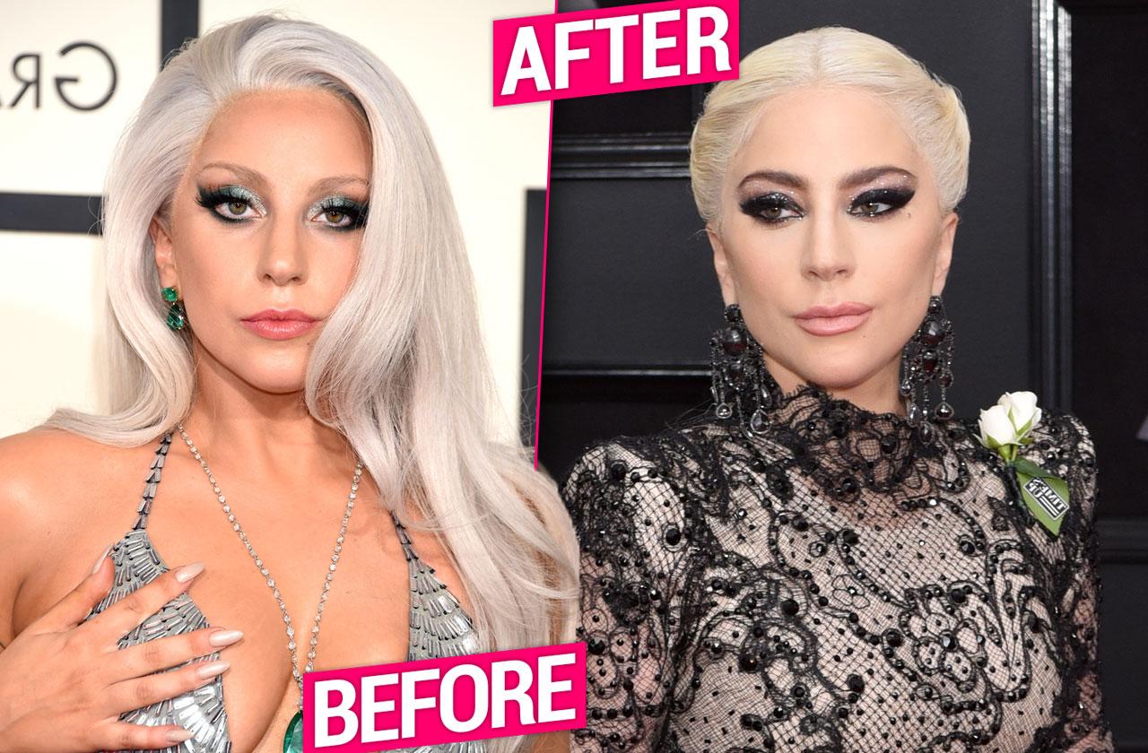 Did Lady Gaga Get Plastic Surgery For Grammys Singer Underwent Brow