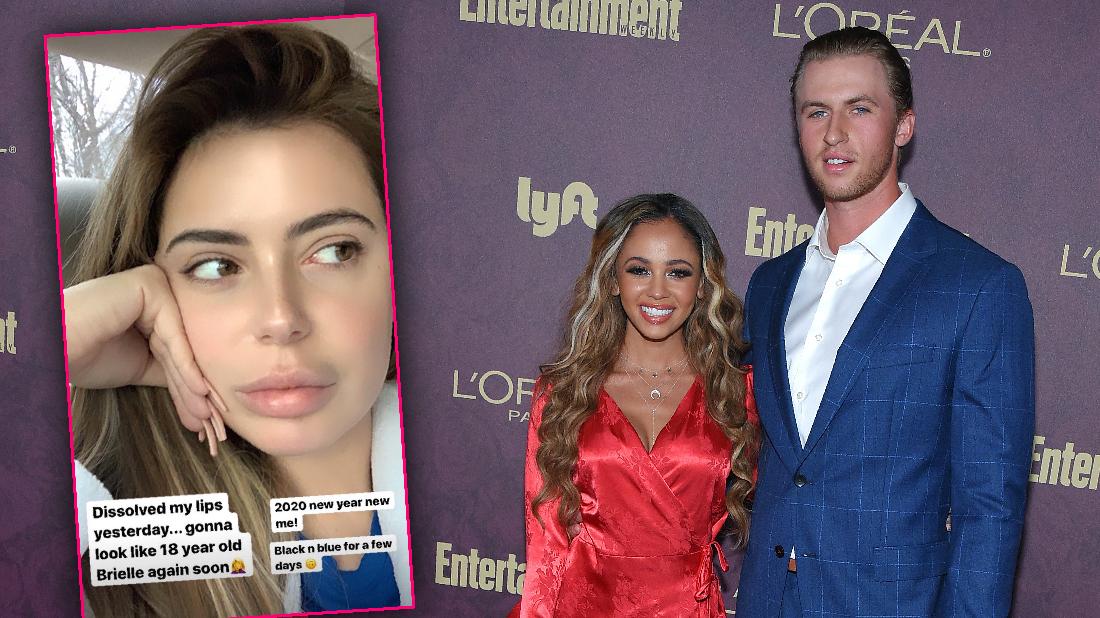 Brielle Biermann Dissolves Lip Fillers As Ex Weds