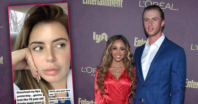 Brielle Biermann Dissolves Lip Fillers As Ex Weds