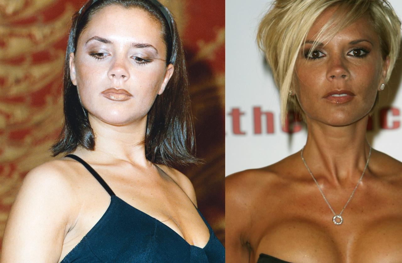 Celebs with breast implants before and after
