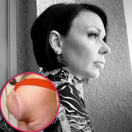 Woman who can FLIP butt implants after botched surgery on the