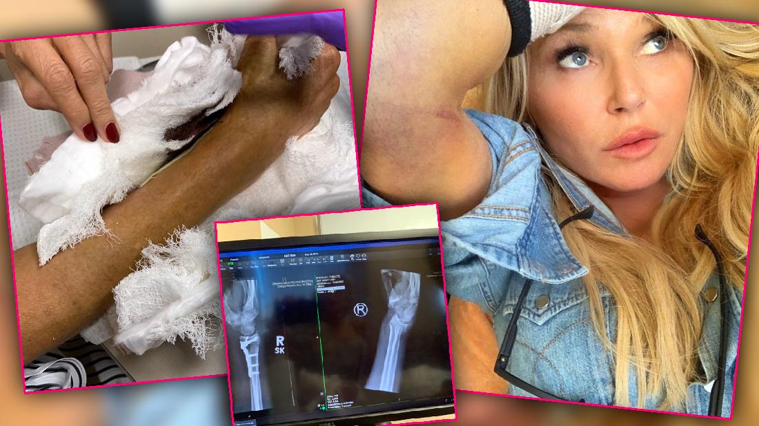 Christie Brinkley Insists She Broke Arm Amid Fakery Claim