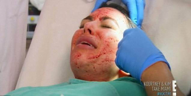 Kim Kardashian Blood Facial