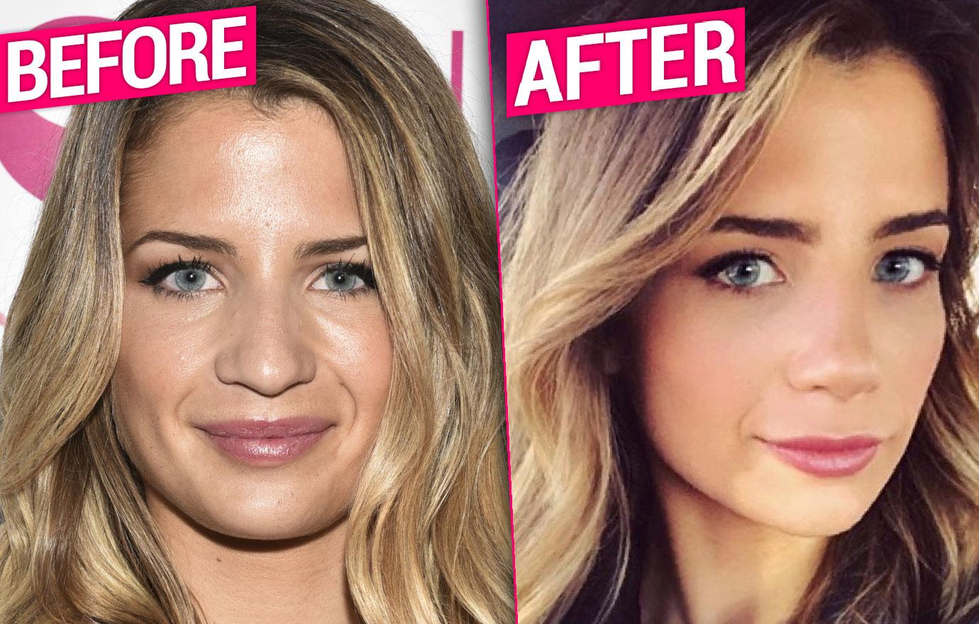 Naomie Olindo Nose Job