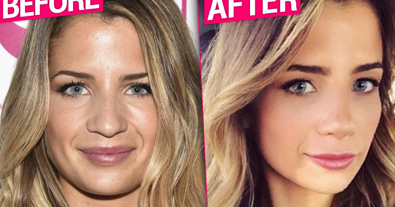 Naomie Olindo Nose Job