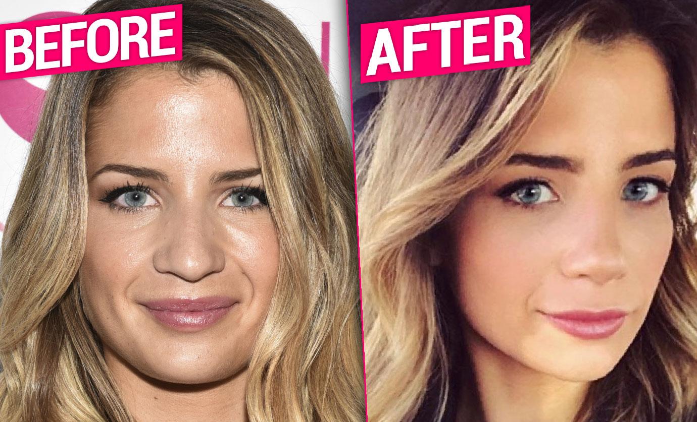 Naomie Olindo Nose Job