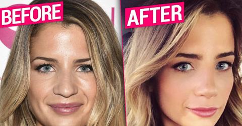 Naomie Olindo Nose Job