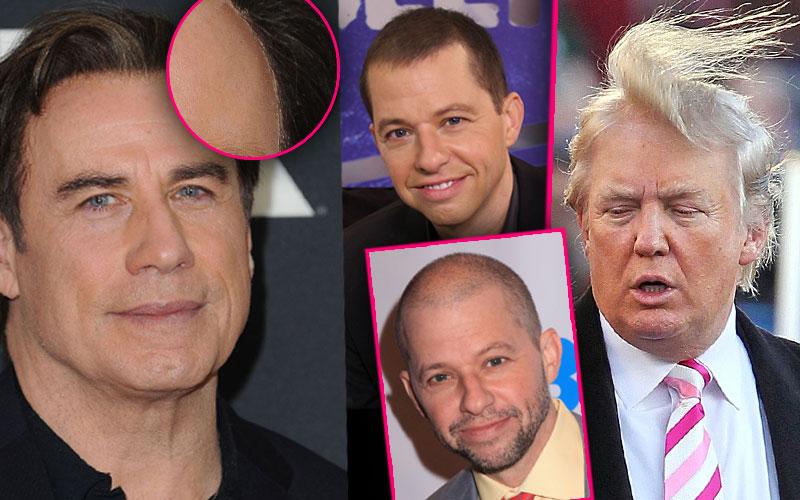 Celebrities Who Are Covering Up Their Bald Spots Receding Hairlines