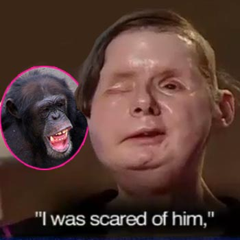 woman attacked by chimpanzee face without surgery