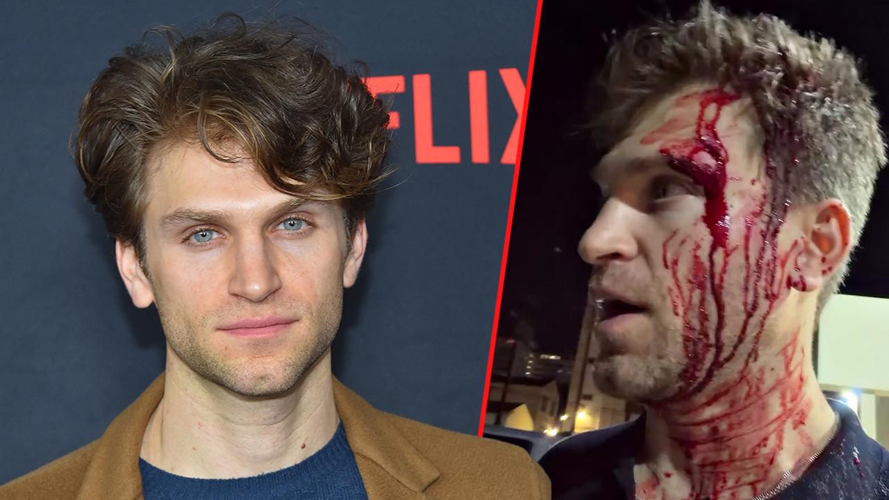 'Pretty Little Liar' star Keegan Allen was left covered in blood after he was robbed.