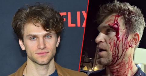 'Pretty Little Liar' star Keegan Allen was left covered in blood after he was robbed.