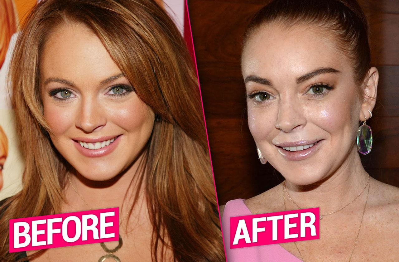 Lindsay Lohan's Plastic Surgery Makeover Exposed By Top Docs