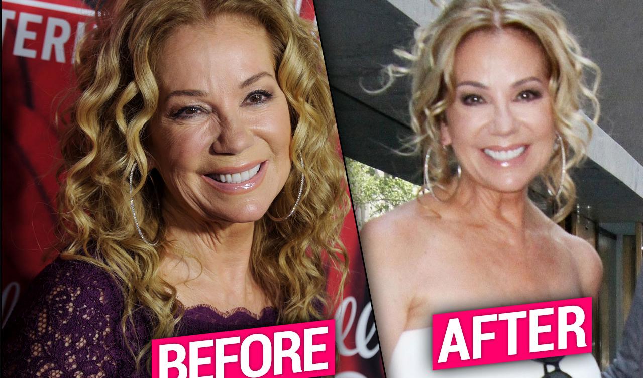 Kathie Lee Gifford Plastic Surgery Makeover Exposed By Top Doctors