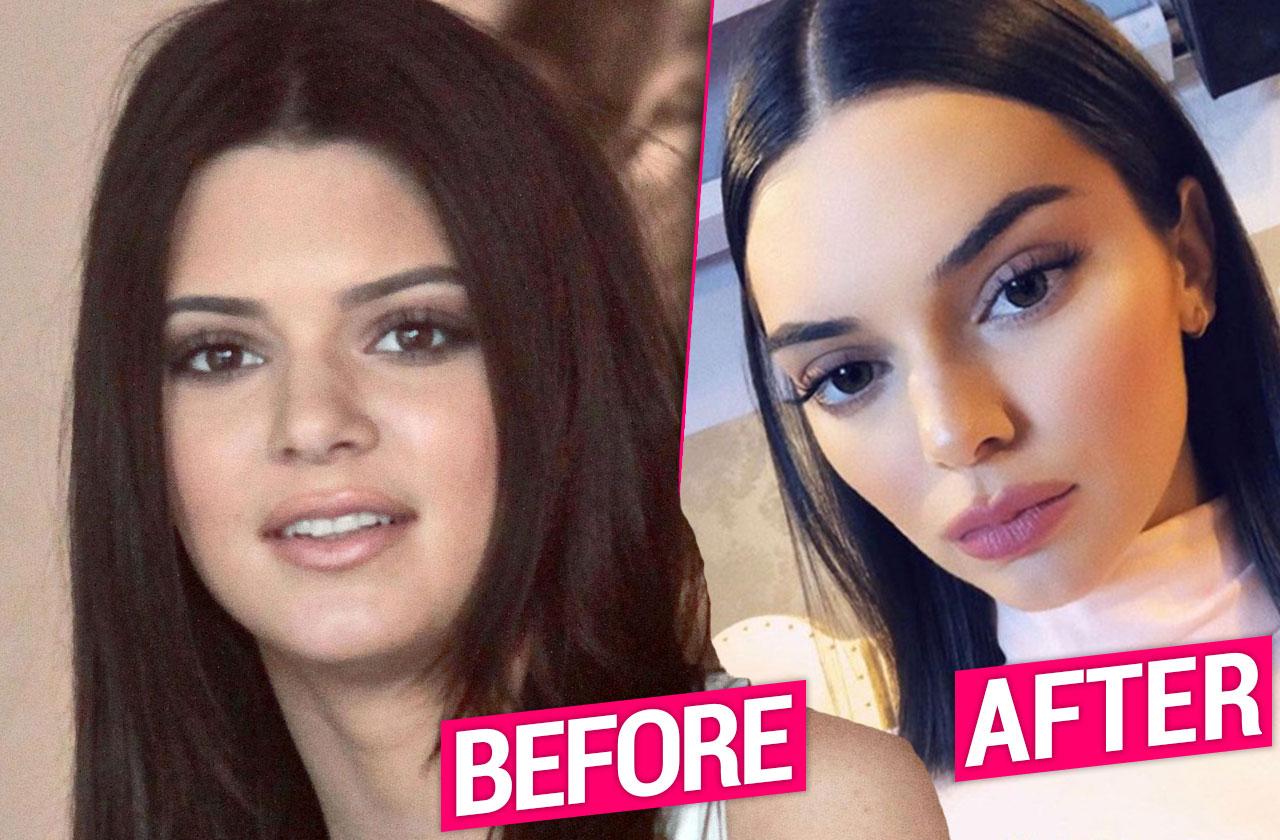 Kendall Jenner Unrecognizable After Plastic Surgery Makeover