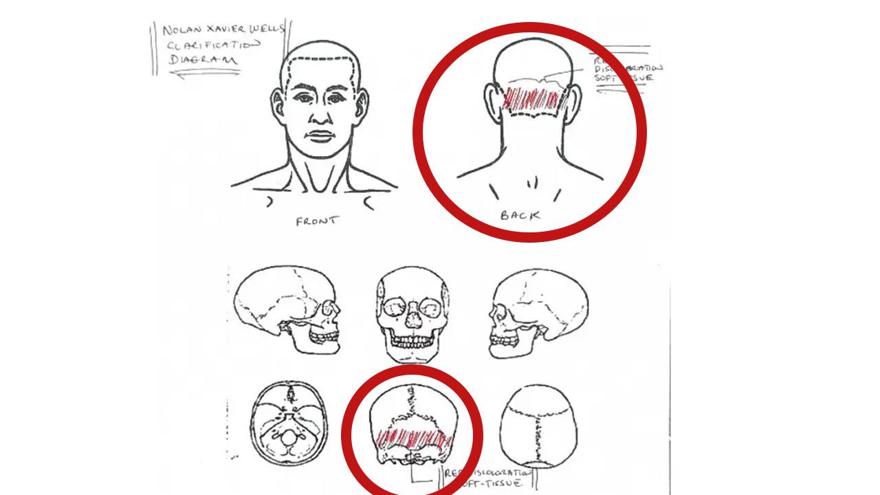 The autopsy report noted unexplained 'red discoloration' on Wells' neck.