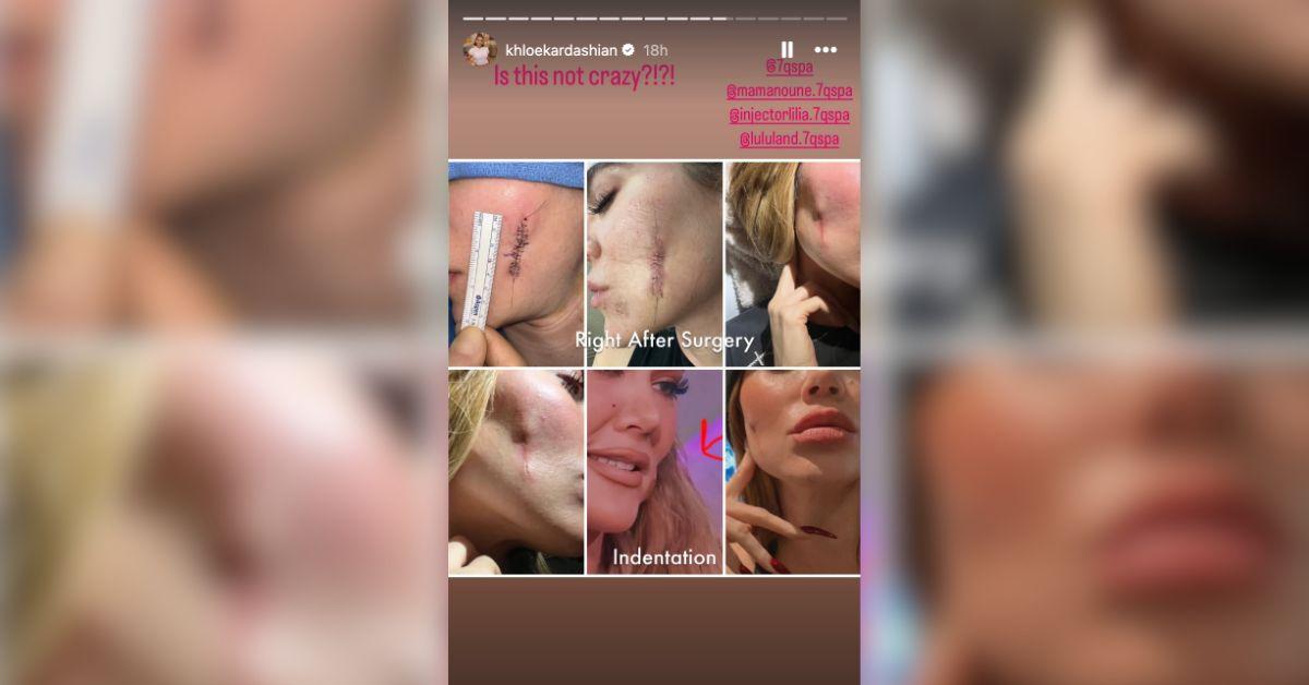khloe kardashian cancer