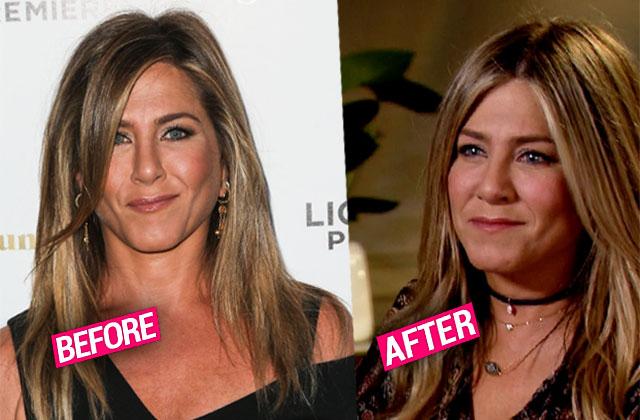 jennifer aniston fillers