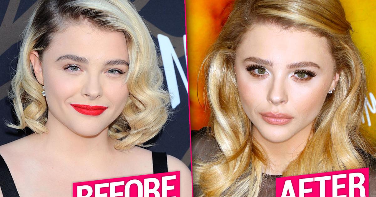 Chloë Grace Moretz Plastic Surgery Speculation Nose Job & Lip Fillers