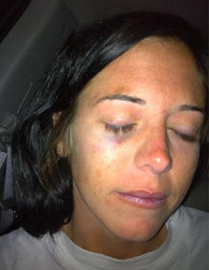 PHOTOS: Jemmye Carroll With Black Eye