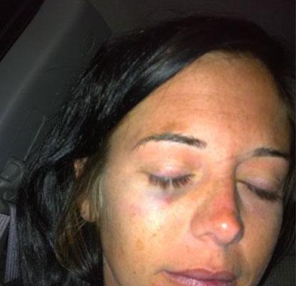 PHOTOS: Jemmye Carroll With Black Eye