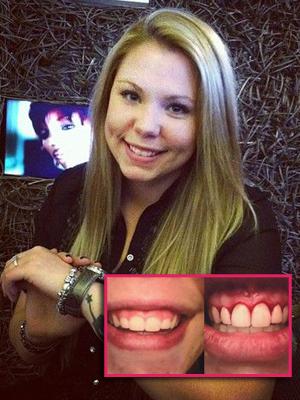 //kailyn lowry gum surgery pp tall