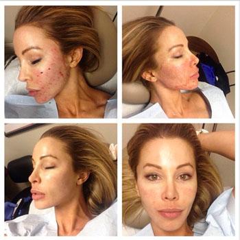 //lisa hochstein gets vampire facial