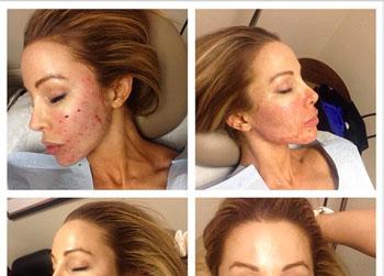 //lisa hochstein gets vampire facial