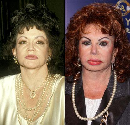 //jackie stallone plastic surgery before after