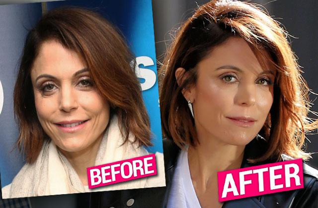 Bethenny Frankel Plastic Surgery