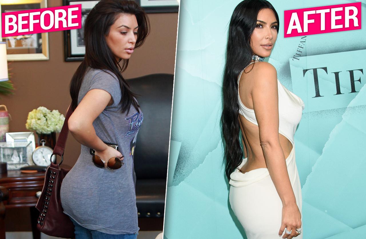 Kim Kardashian Gets Butt Implants Removed Claim Plastic Surgeons